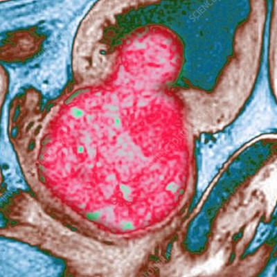 Quale trattamento chirurgico per prostate di grandi dimensioni?