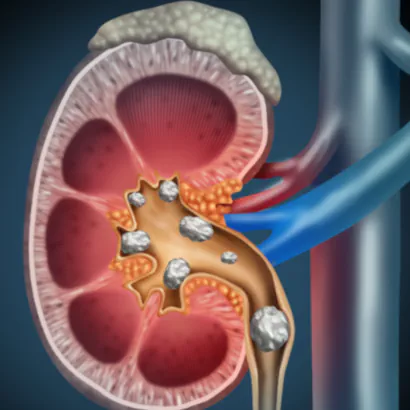 Calcoli renali dopo l'estate: come evitare una nuova colica